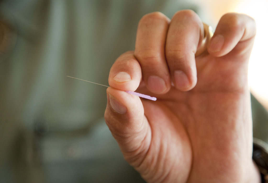 Point taken Licensed acupuncturists provide relief for variety of